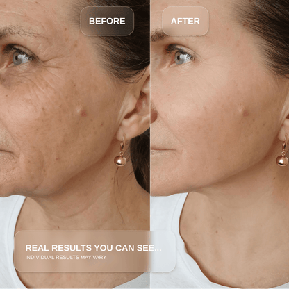Red Light Therapy Wand for Face & Anti-Aging Device results before and after showing reduction in fine lines